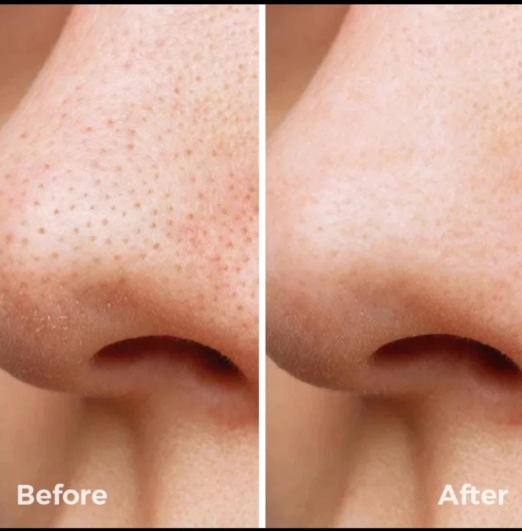 Vaccum Pore Cleaner
